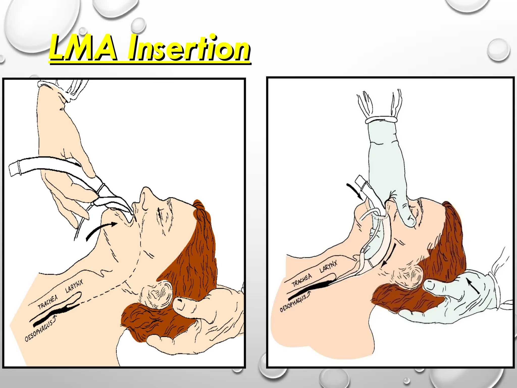 LMA Insertion
LMA Insertion
 