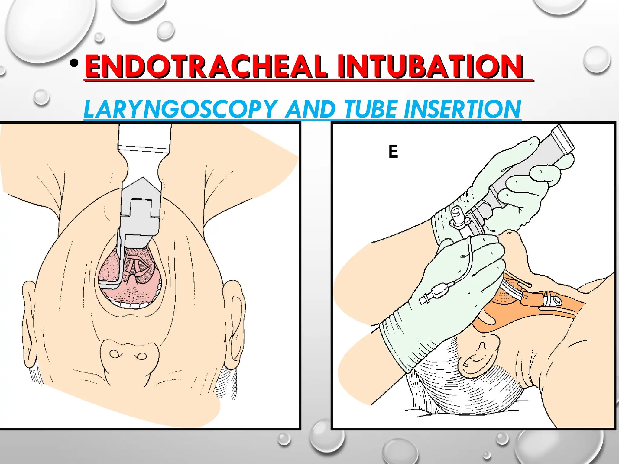 •ENDOTRACHEAL INTUBATION
ENDOTRACHEAL INTUBATION
LARYNGOSCOPY AND TUBE INSERTION
 