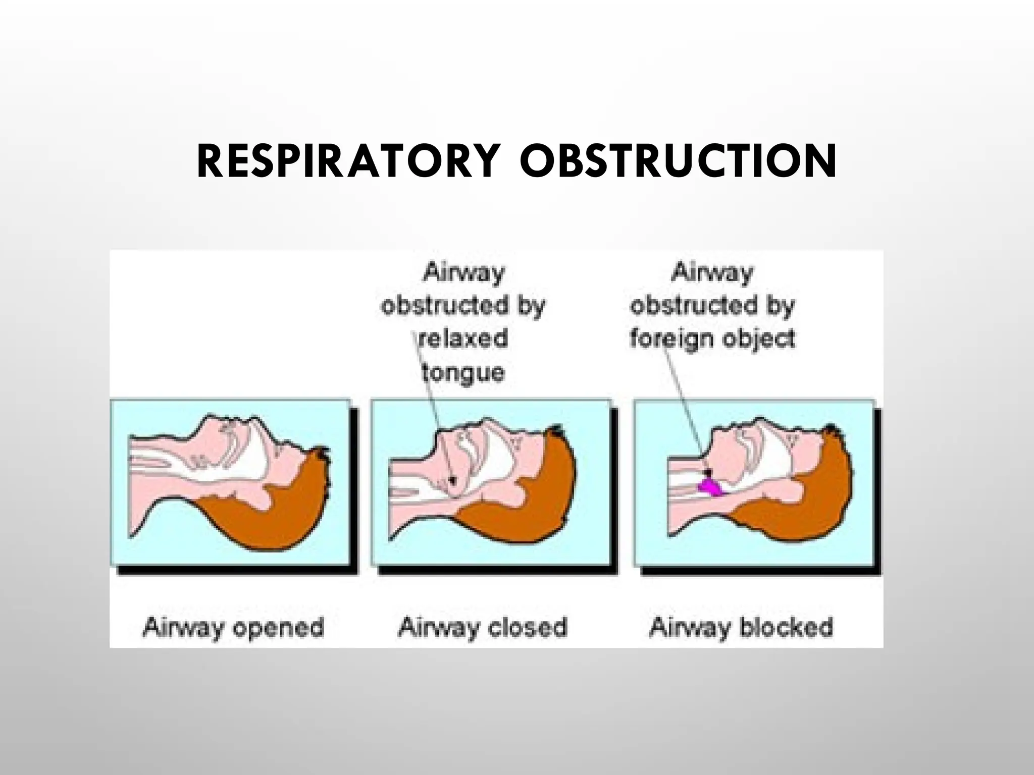 RESPIRATORY OBSTRUCTION
 