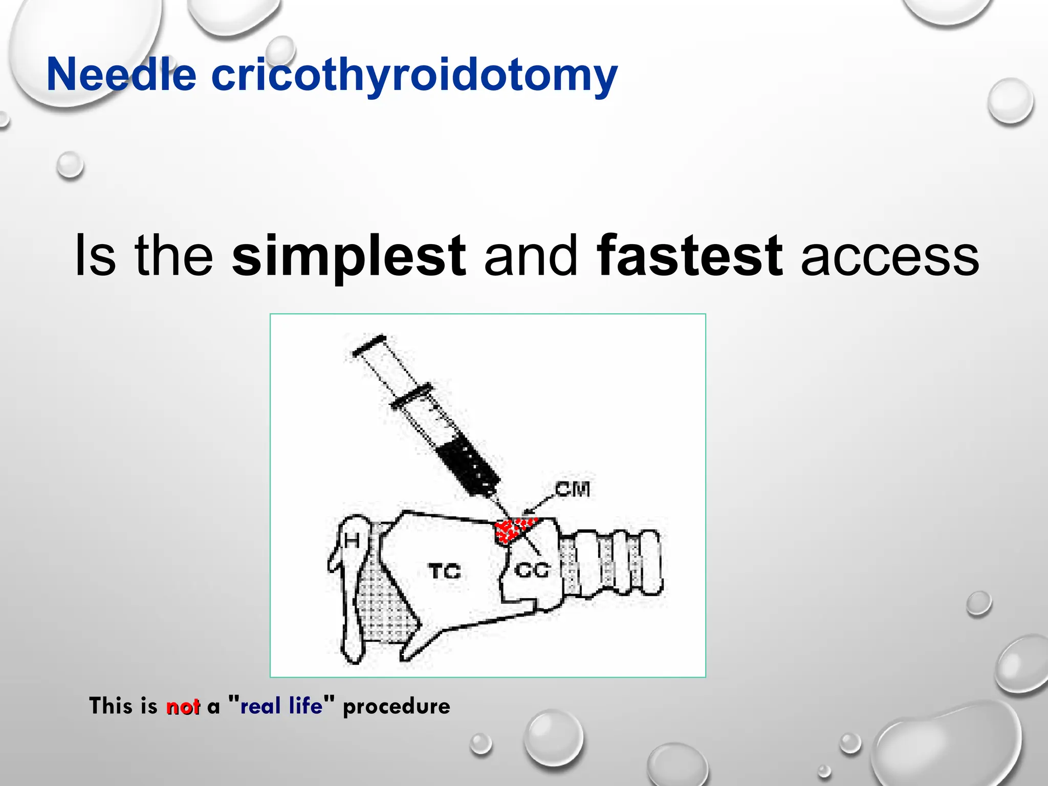 Needle cricothyroidotomy
Is the simplest and fastest access
This is not
not a "real life" procedure
 