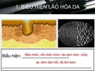 1. BIỂU HIỆN LÃO HÓA DA
Biểu hiện: ____________________
______________________________________
Nếp nhăn, vết chân chim, da sạm nám, chảy
xệ, kém đán hồi, độ ẩm kém.
 