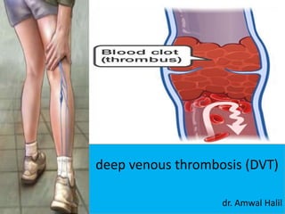 deep venous thrombosis (DVT)
dr. Amwal Halil
 