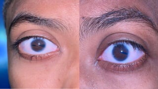 AXENFELD RIGER SYNDROME in detail explanation | PPTX