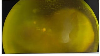AXENFELD RIGER SYNDROME in detail explanation | PPTX