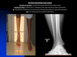 ANTERO POSTERIOR COM CARGA
          POSIÇÃO DO PACIENTE : PACIENTE EM POSIÇÃO ORTOSTÁTICA SOBRE A MESA
  POSIÇÃO DA PARTE: ALINHAR O PÉ E O TORNOZELO PARA UMA POSIÇÃO DE FRENTE VERDADEIRA.
RC: RAIO CENTRAL PERPENDICULAR A ESTRUTURA ENTRANDO 8CM ACIMA DA LINHA INTER MALEOLAR.
                     OBS: O PÉ DEVERÁ SER INCLUIDO NESTA INCIDÊNCIA.
 