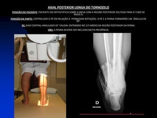 AXIAL POSTERIOR LONGA DO TORNOZELO
 POSIÇÃO DO PACIENTE: PACIENTE EM ORTOSTÁTICA SOBRE A MESA COM A REGIÃO POSTERIOR VOLTADA PARA O TUBO DE
                                                 RAIOS-X.
POSIÇÃO DA PARTE: CENTRALIZAR O PÉ EM RELAÇÃO A PERNA(SEM ROTAÇÃO). O PÉ E A PERNA FORMARÃO UM ÂNGULO DE
                                                    90°.
        RC: RAIO CENTRAL ANGULADO 45° CAUDAL ENTRANDO NO 1/3 MÉDIO DA REGIÃO POSTERIOR DA PERNA.
                            OBS: A PERNA DEVERÁ SER INCLUIDA NESTA INCIDÊNCIA.
 