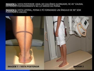 IMAGEM 1: VISTA POSTERIOR AXIAL DO CALCÂNEO ALONGADO, RC 45° CAUDAL
ENTRANDO POSTERIORMENTE NO 1/3 MÉDIO DA PERNA.
IMAGEM 2: VISTA LATERAL, PERNA E PÉ FORMANDO UM ÂNGULO DE 90° SEM
FLEXIONAR O JOELHO.




 IMAGEM 1 – VISTA POSTERIOR                               IMAGEM 2
 