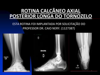 ROTINA CALCÂNEO AXIAL
POSTERIOR LONGA DO TORNOZELO
ESTA ROTINA FOI IMPLANTADA POR SOLICITAÇÃO DO
      PROFESSOR DR. CAIO NERY. (1127387)
 