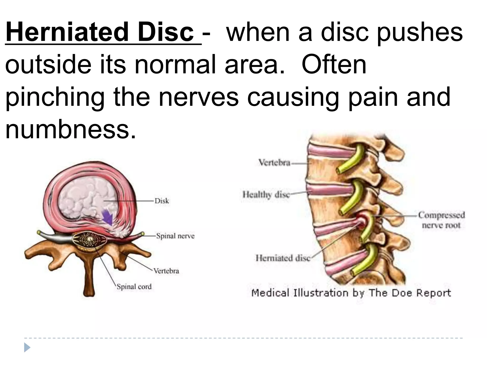 Herniated Disc - when a disc pushes
outside its normal area. Often
pinching the nerves causing pain and
numbness.
 