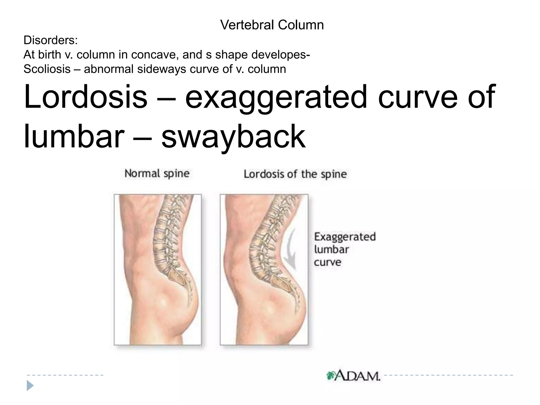 Vertebral Column
Disorders:
At birth v. column in concave, and s shape developes-
Scoliosis – abnormal sideways curve of v. column

Lordosis – exaggerated curve of
lumbar – swayback
 