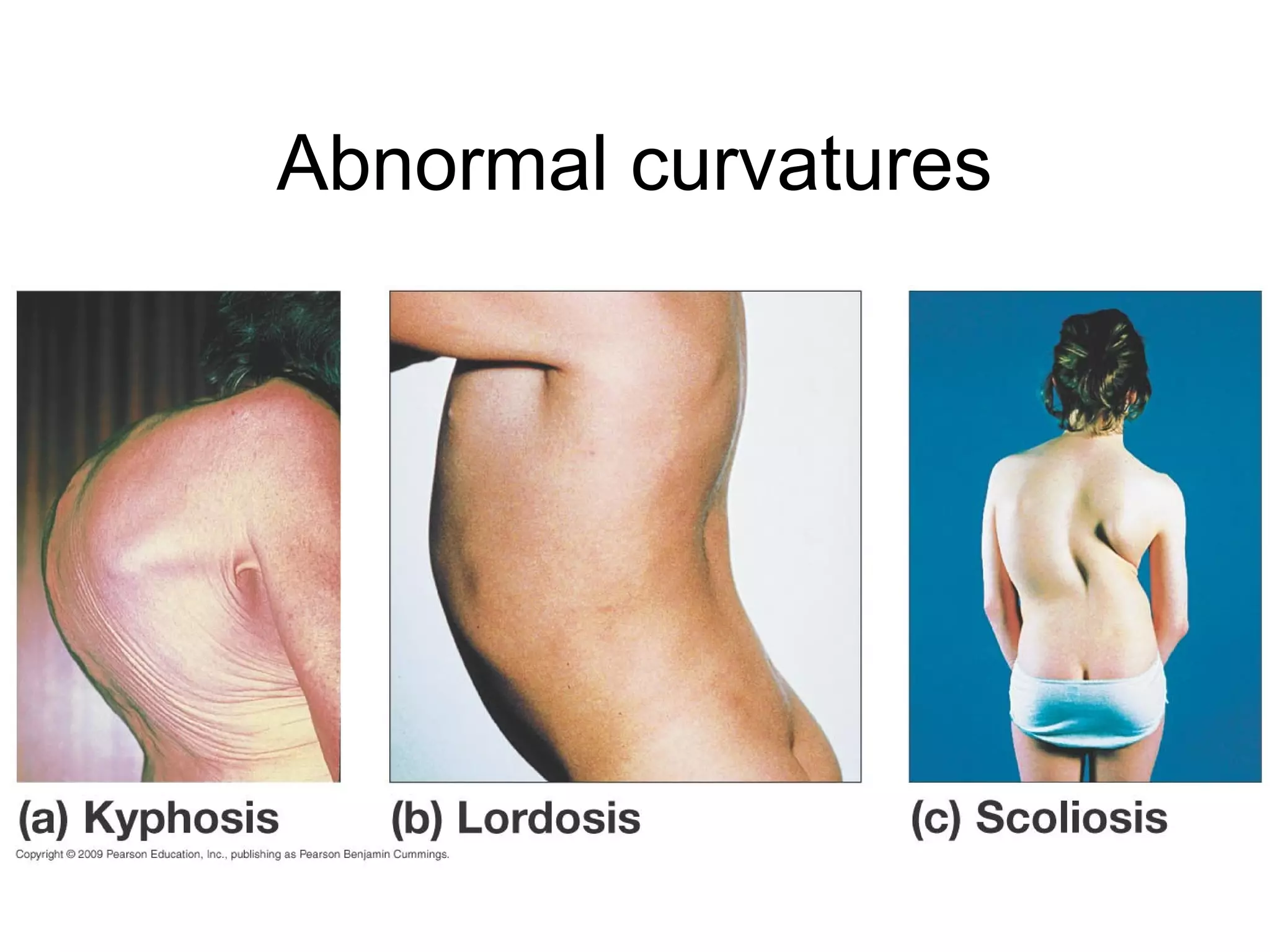 Abnormal curvatures
 