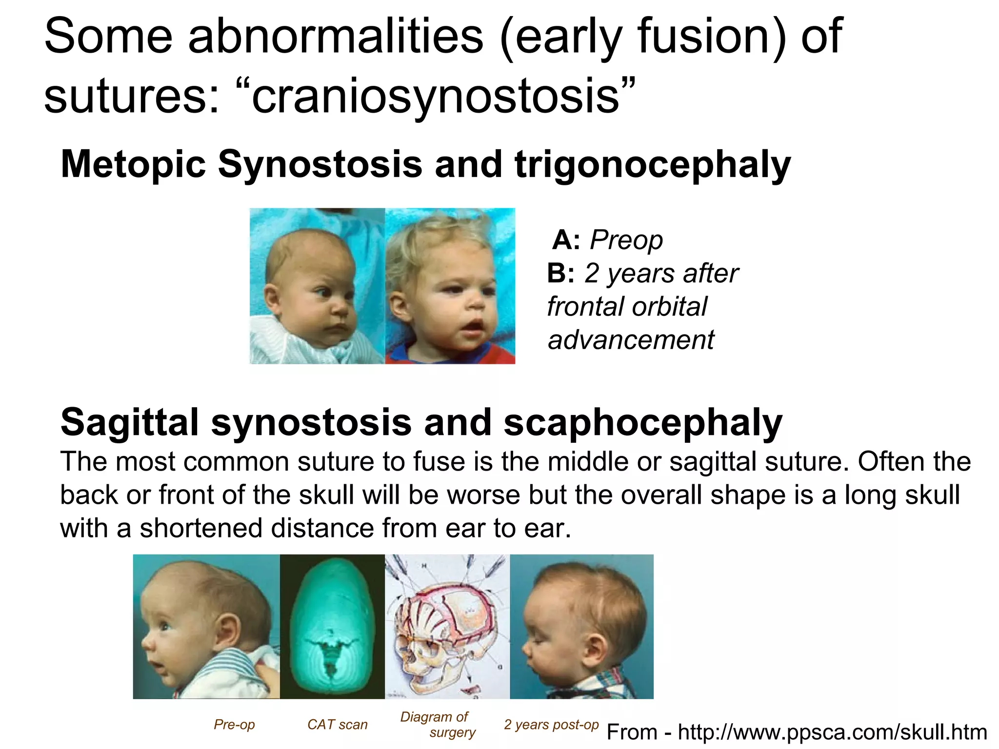 Some abnormalities (early fusion) of
sutures: “craniosynostosis”
Metopic Synostosis and trigonocephaly
A: Preop
B: 2 years after
frontal orbital
advancement
Pre-op CAT scan
Diagram of
surgery
2 years post-op
Sagittal synostosis and scaphocephaly
The most common suture to fuse is the middle or sagittal suture. Often the
back or front of the skull will be worse but the overall shape is a long skull
with a shortened distance from ear to ear.
From - http://www.ppsca.com/skull.htm
 