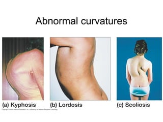 Abnormal curvatures
 