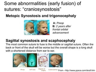 Some abnormalities (early fusion) of
sutures: “craniosynostosis”
Metopic Synostosis and trigonocephaly
A: Preop
B: 2 years after
frontal orbital
advancement
Pre-op CAT scan
Diagram of
surgery
2 years post-op
Sagittal synostosis and scaphocephaly
The most common suture to fuse is the middle or sagittal suture. Often the
back or front of the skull will be worse but the overall shape is a long skull
with a shortened distance from ear to ear.
From - http://www.ppsca.com/skull.htm
 
