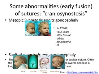 Some abnormalities (early fusion)
of sutures: “craniosynostosis”
• Metopic Synostosis and trigonocephaly
• A: Preop
•B: 2 years
after frontal
orbital
advanceme
nt
• Sagittal synostosis and scaphocephaly
• The most common suture to fuse is the middle or sagittal suture. Often
the back or front of the skull will be worse but the overall shape is a
long skull with a shortened distance from ear to ear.
Pre-op CAT scan
Diagram of
surgery
2 years post-op
From - http://www.ppsca.com/skull.htm
 