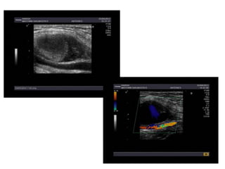 Axillary artery pseudoaneurysm