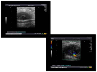 Axillary artery pseudoaneurysm