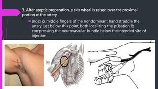 Axillary Block | PPTX