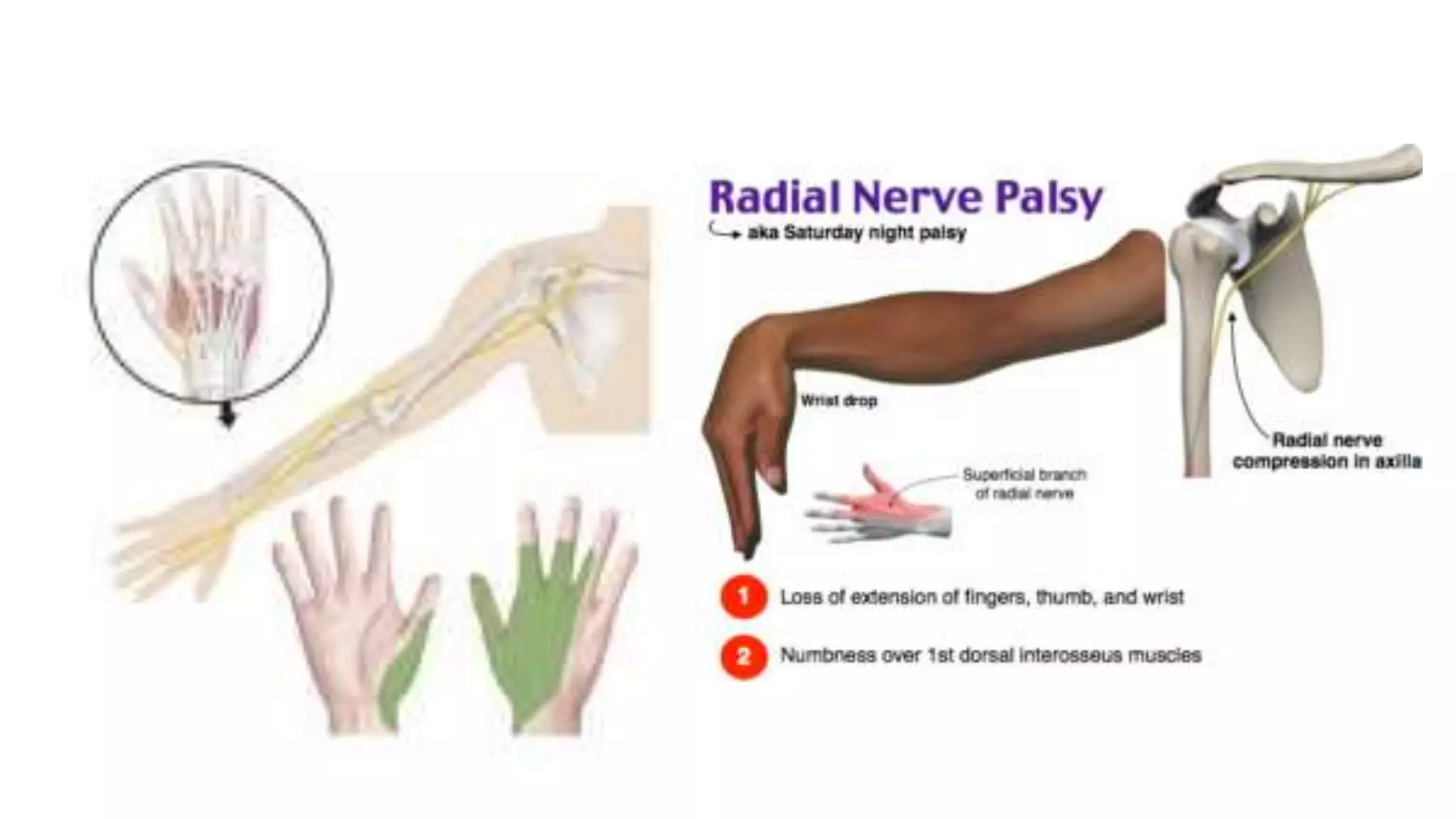 Axillary, Musculocutaneous & Radial Nerve.pptx
