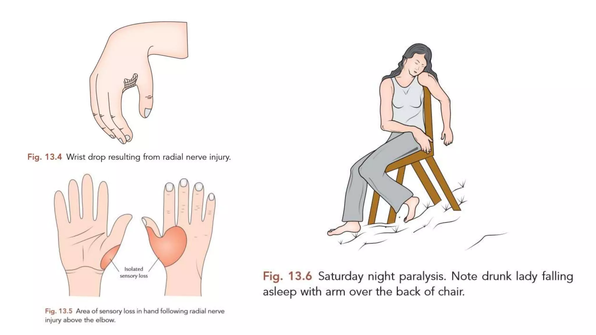 Axillary, Musculocutaneous & Radial Nerve.pptx