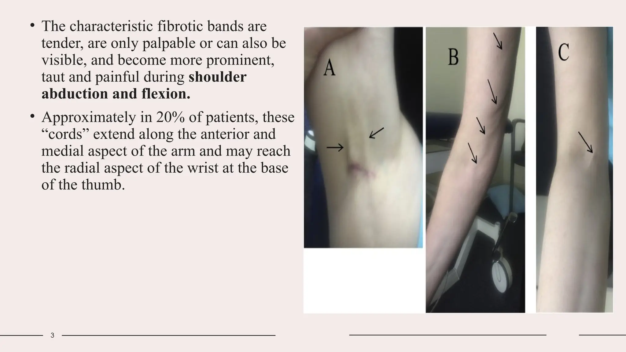 Photographs showing axillary web syndrome cords along the inner forearm and arm