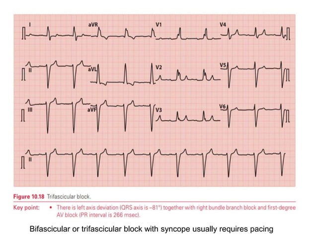 AXIS, TYPES OF AXIS IN ECG AND HOW TO INTERPRET IN ECG? | PPTX