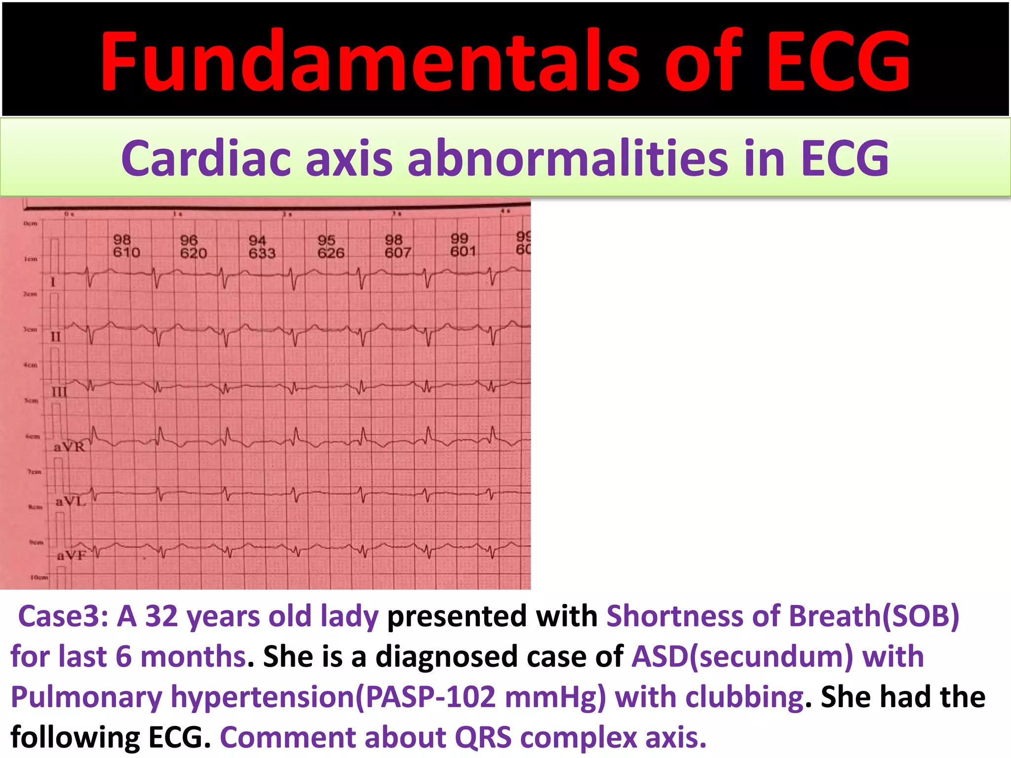 Fundamentals of ECG
Cardiac axis abnormalities in ECG
Case3: A 32 years old lady presented with Shortness of Breath(SOB)
for last 6 months. She is a diagnosed case of ASD(secundum) with
Pulmonary hypertension(PASP-102 mmHg) with clubbing. She had the
following ECG. Comment about QRS complex axis.
 