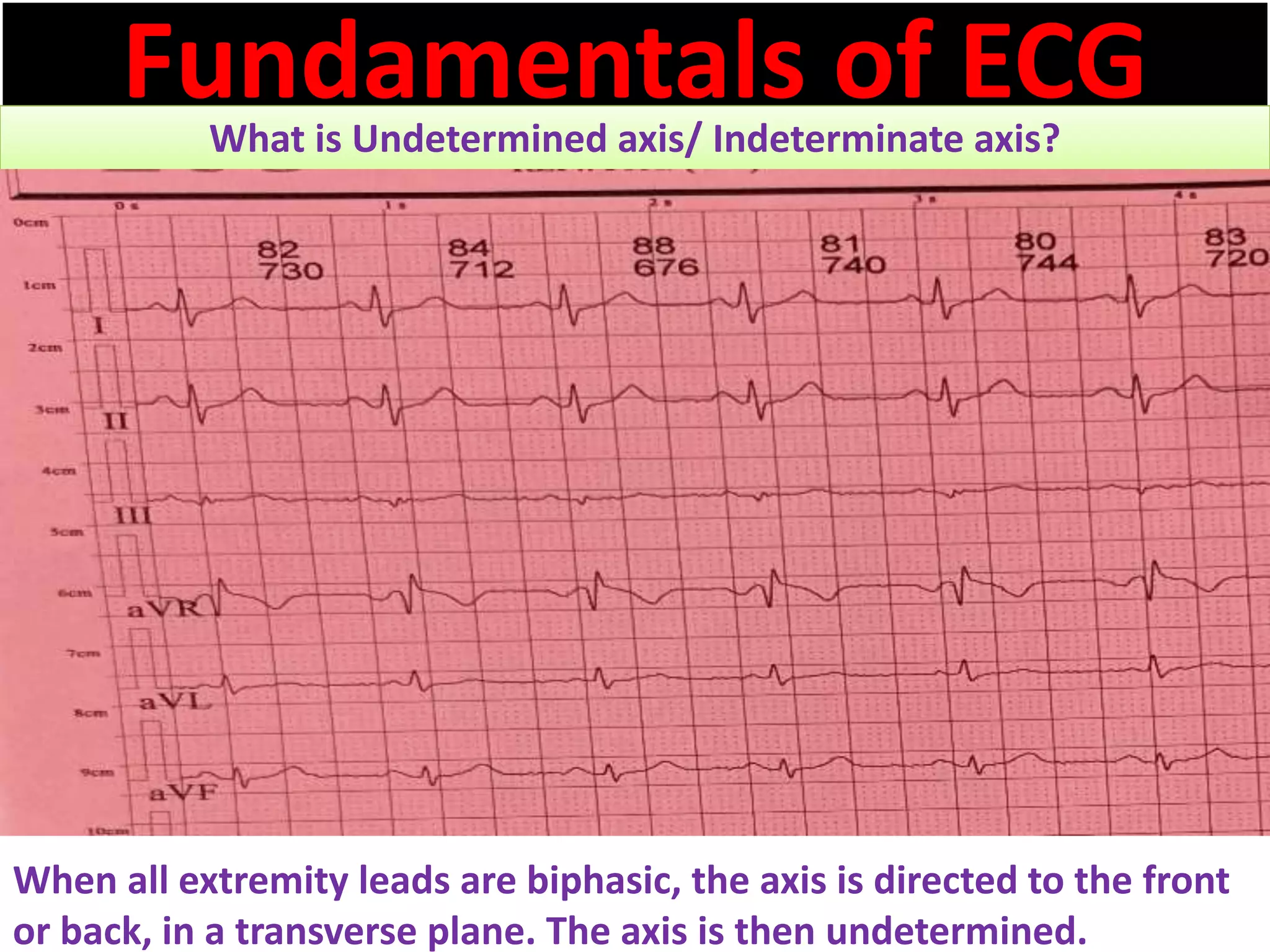 Fundamentals of ECGWhat is Undetermined axis/ Indeterminate axis?
When all extremity leads are biphasic, the axis is directed to the front
or back, in a transverse plane. The axis is then undetermined.
 