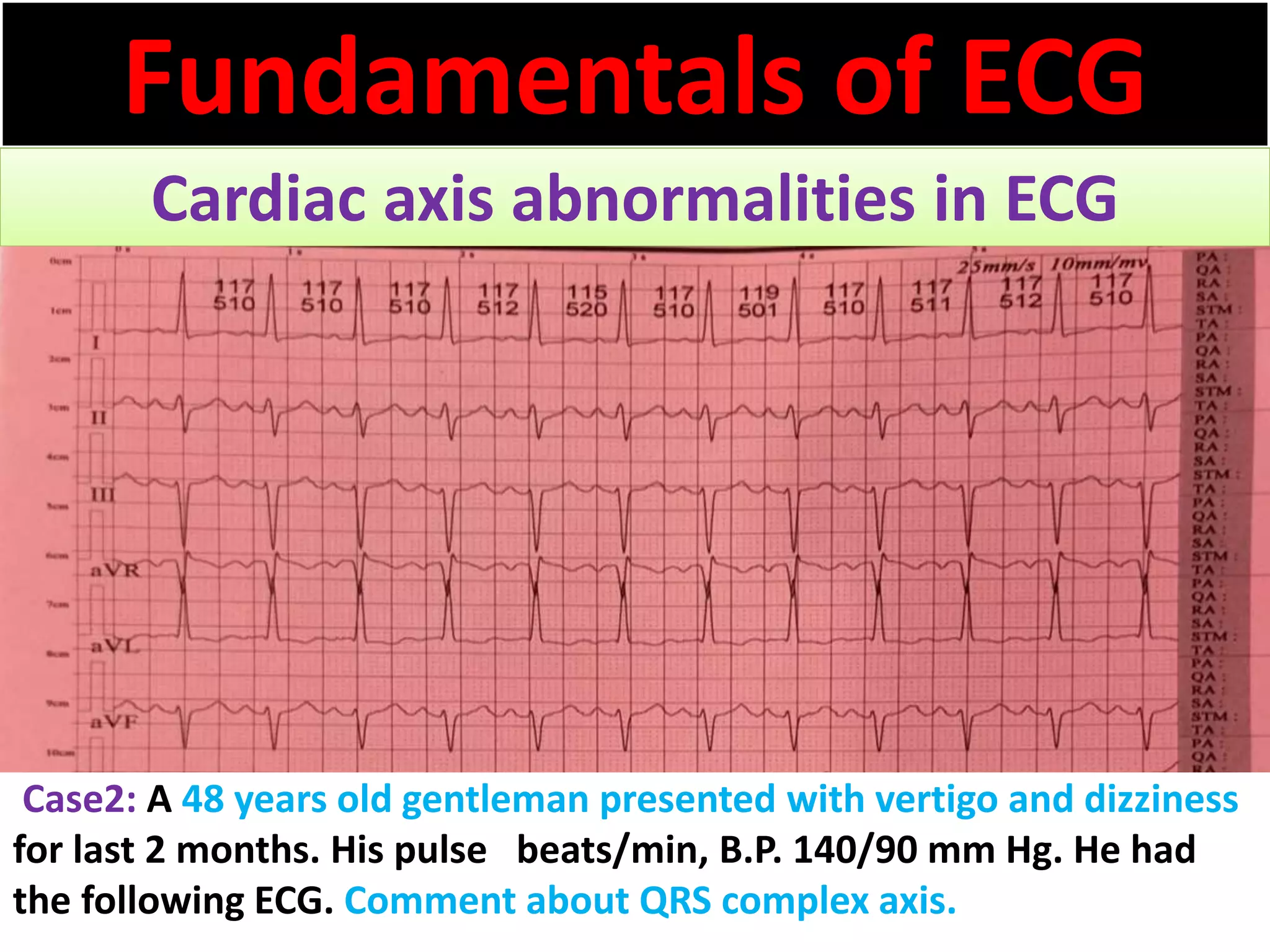 Fundamentals of ECG
Cardiac axis abnormalities in ECG
Case2: A 48 years old gentleman presented with vertigo and dizziness
for last 2 months. His pulse beats/min, B.P. 140/90 mm Hg. He had
the following ECG. Comment about QRS complex axis.
 