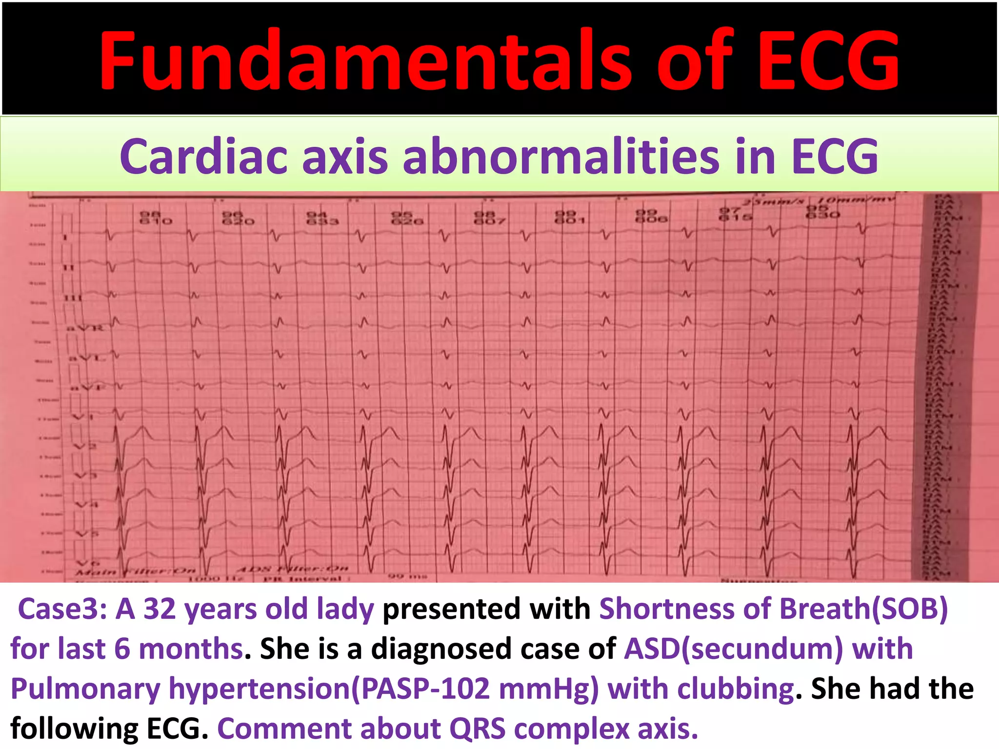 Fundamentals of ECG
Cardiac axis abnormalities in ECG
Case3: A 32 years old lady presented with Shortness of Breath(SOB)
for last 6 months. She is a diagnosed case of ASD(secundum) with
Pulmonary hypertension(PASP-102 mmHg) with clubbing. She had the
following ECG. Comment about QRS complex axis.
 