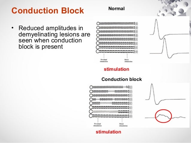 Nerves conduction study, Axonal loss vs Demyelination emg block diagram 