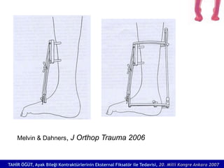 Melvin & Dahners, J Orthop Trauma 2006



TAHİR ÖĞÜT, Ayak Bileği Kontraktürlerinin Eksternal Fiksatör ile Tedavisi, 20. M...