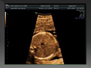 TEMEL FETAL KARDİYAK İNCELEME 