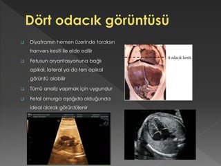  Diyaframın hemen üzerinde toraksın
tranvers kesiti ile elde edilir
 Fetusun oryantasyonuna bağlı
apikal, lateral ya da ters apikal
görüntü alabilir
 Tümü analiz yapmak için uygundur
 Fetal omurga aşağıda olduğunda
ideal olarak görüntülenir
 