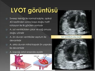  Sweep tekniği ile normal kalpte, apikal
4O kesitinden sonra başa doğru hafif
rotasyon ile ilk görülen aortadır
 A. sol ventrikülden çıkar ve sağ omuza
doğru yönelir
 A. ön duvarı ventriküler septum ile
devamlıdır
 A. arka duvarı mitral kapak ön yaprakcık
ile devamlıdır
 A. kapağı sistol sırasında açıktır
Sol ventrikül çıkış kesiti
 