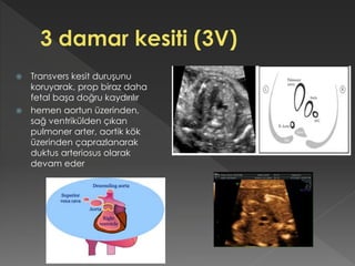  Transvers kesit duruşunu
koruyarak, prop biraz daha
fetal başa doğru kaydırılır
 hemen aortun üzerinden,
sağ ventrikülden çıkan
pulmoner arter, aortik kök
üzerinden çaprazlanarak
duktus arteriosus olarak
devam eder
 