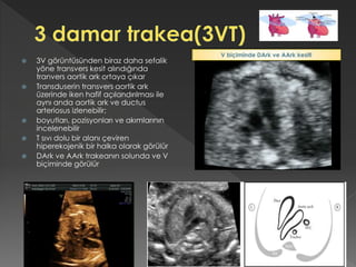  3V görüntüsünden biraz daha sefalik
yöne transvers kesit alındığında
tranvers aortik ark ortaya çıkar
 Transduserin transvers aortik ark
üzerinde iken hafif açılandırılması ile
aynı anda aortik ark ve ductus
arteriosus izlenebilir;
 boyutları, pozisyonları ve akımlarının
incelenebilir
 T sıvı dolu bir alanı çeviren
hiperekojenik bir halka olarak görülür
 DArk ve AArk trakeanın solunda ve V
biçiminde görülür
V biçiminde DArk ve AArk kesiti
 