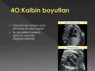  Normal kalp toraksın üçte
biri kadar bir alan kaplar
 Bu genellikle hareketli
görüntü sırasında
değerlendirilebilir
Kardiyomegali
Normal kalp boyutu
 