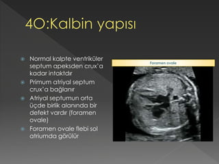  Normal kalpte ventriküler
septum apeksden crux’a
kadar intaktdır
 Primum atriyal septum
crux’a bağlanır
 Atriyal septumun orta
üçde birlik alanında bir
defekt vardır (foramen
ovale)
 Foramen ovale flebi sol
atriumda görülür
Foramen ovale
 