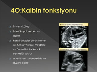  İki ventrikül eşit
 İki AV kapak serbest ve
açıktır
 Renkli doppler görüntüleme
ile, her iki ventrikül eşit dolar
ve önemli bir AV kapak
yemezliği yoktur
 A ve V senkronize şekilde ve
düzenli çalışır
Anormal sol ventrikül kontraktilitesi
Normal ventrikül kontraktilitesi
 