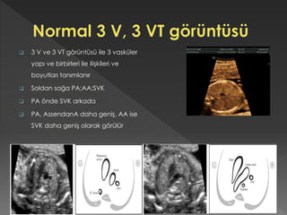  3 V ve 3 VT görüntüsü ile 3 vasküler
yapı ve birbirleri ile ilişkileri ve
boyutları tanımlanır
 Soldan sağa PA;AA;SVK
 PA önde SVK arkada
 PA, AssendanA daha geniş, AA ise
SVK daha geniş olarak görülür
 