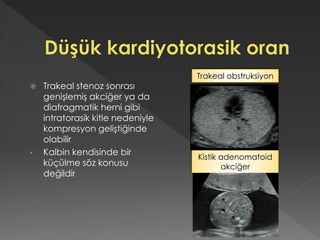  Trakeal stenoz sonrası
genişlemiş akciğer ya da
diafragmatik herni gibi
intratorasik kitle nedeniyle
kompresyon geliştiğinde
olabilir
• Kalbin kendisinde bir
küçülme söz konusu
değildir
Trakeal obstruksiyon
Kistik adenomatoid
akciğer
 