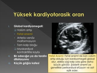 I. Global kardiyomegali:
 Volüm artışı
• Fetal anemi
• Arterio-venöz
malformasyon
• Tam kalp bloğu
 Myokardiyal
kontraktilite kaybı
II. Bir odacığın ya da tarafın
dilatasyonu
III. Küçük göğüs kafesi
Fetal Anemi: Fetal anemi’de kan volüm
artışı olduğu için kardiyomegeli global
olur, sıklıkla sağ kalp sola göre daha
büyük görülür. Şiddetli anemi’ye
genellikle perikardiyal efüzyon ve asit
eşlik eder.
 