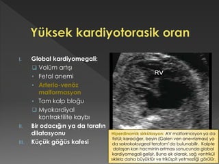 I. Global kardiyomegali:
 Volüm artışı
• Fetal anemi
• Arterio-venöz
malformasyon
• Tam kalp bloğu
 Myokardiyal
kontraktilite kaybı
II. Bir odacığın ya da tarafın
dilatasyonu
III. Küçük göğüs kafesi
Hiperdinamik sirkülasyon: AV malformasyon ya da
fistül; karaciğer, beyin (Galen ven anevrizması) ya
da sakrokoksygeal teratom’da bulunabilir. Kalpte
dolaşan kan hacminin artması sonucunda global
kardiyomegali gelişir. Buna ek olarak, sağ ventrikül
sıklıkla daha büyüktür ve triküspit yetmezliği görülür.
 