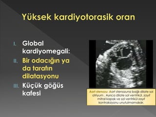 I. Global
kardiyomegali:
II. Bir odacığın ya
da tarafın
dilatasyonu
III. Küçük göğüs
kafesi Aort stenozu: Aort stenozuna bağlı dilate sol
atriyum . Ayrıca dilate sol ventrikül, zayıf
mitral kapak ve sol ventrikül zayıf
kontraksiyonu unutulmamalıdır.
 