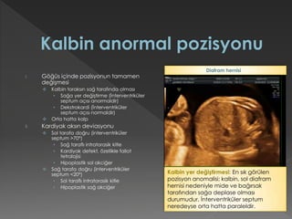 I. Göğüs içinde pozisyonun tamamen
değişmesi
 Kalbin toraksın sağ tarafında olması
• Sağa yer değiştirme (İnterventriküler
septum açısı anormaldir)
• Dekstrokardi (İnterventriküler
septum açısı normaldir)
 Orta hatta kalp
II. Kardiyak aksın deviasyonu
 Sol tarafa doğru (interventriküler
septum >70°)
• Sağ taraflı intratorasik kitle
• Kardiyak defekt, özellikle fallot
tetralojisi
• Hipoplastik sol akciğer
 Sağ tarafa doğru (interventriküler
septum <20°)
• Sol taraflı intratorasik kitle
• Hipoplastik sağ akciğer
Kalbin yer değiştirmesi: En sık görülen
pozisyon anomalisi; kalbin, sol diafram
hernisi nedeniyle mide ve bağırsak
tarafından sağa deplase olması
durumudur. İnterventriküler septum
neredeyse orta hatta paraleldir.
Diafram hernisi
 