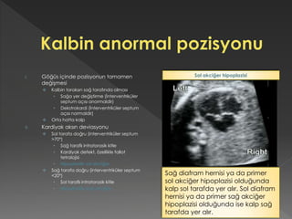 I. Göğüs içinde pozisyonun tamamen
değişmesi
 Kalbin toraksın sağ tarafında olması
• Sağa yer değiştirme (İnterventriküler
septum açısı anormaldir)
• Dekstrokardi (İnterventriküler septum
açısı normaldir)
 Orta hatta kalp
II. Kardiyak aksın deviasyonu
 Sol tarafa doğru (interventriküler septum
>70°)
• Sağ taraflı intratorasik kitle
• Kardiyak defekt, özellikle fallot
tetralojisi
• Hipoplastik sol akciğer
 Sağ tarafa doğru (interventriküler septum
<20°)
• Sol taraflı intratorasik kitle
• Hipoplastik sağ akciğer
Sağ diafram hernisi ya da primer
sol akciğer hipoplazisi olduğunda
kalp sol tarafda yer alır. Sol diafram
hernisi ya da primer sağ akciğer
hipoplazisi olduğunda ise kalp sağ
tarafda yer alır.
Sol akciğer hipoplazisi
 