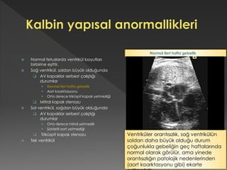  Normal fetuslarda ventrikül boyutları
birbirine eşittir.
 Sağ ventrikül, soldan büyük olduğunda
 AV kapaklar serbest çalıştığı
durumlar
 Normal ileri hafta gebelik
 Aort koarktasyonu
 Orta derece triküspit kapak yetmezliği
 Mitral kapak stenozu
 Sol ventrikül, sağdan büyük olduğunda
 AV kapaklar serbest çalıştığı
durumlar
 Orta derece mitral yetmezlik
 Şiddetli aort yetmezliği
 Triküspit kapak stenozu
 Tek ventrikül
Ventriküler orantısızlık, sağ ventrikülün
soldan daha büyük olduğu durum
çoğunlukla gebeliğin geç haftalarında
normal olarak görülür, ama yinede
orantısızlığın patolojik nedenlerinden
(aort koarktasyonu gibi) ekarte
Normal ileri hafta gebelik
 