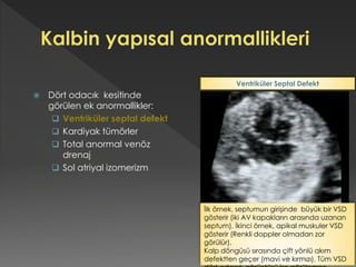  Dört odacık kesitinde
görülen ek anormallikler:
 Ventriküler septal defekt
 Kardiyak tümörler
 Total anormal venöz
drenaj
 Sol atriyal izomerizm
İlk örnek, septumun girişinde büyük bir VSD
gösterir (iki AV kapakların arasında uzanan
septum). İkinci örnek, apikal muskuler VSD
gösterir (Renkli doppler olmadan zor
görülür).
Kalp döngüsü sırasında çift yönlü akım
defektten geçer (mavi ve kırmızı). Tüm VSD
Ventriküler Septal Defekt
 