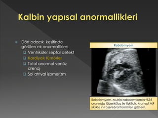  Dört odacık kesitinde
görülen ek anormallikler:
 Ventriküler septal defekt
 Kardiyak tümörler
 Total anormal venöz
drenaj
 Sol atriyal izomerizm
Rabdomyom. Multipl rabdomyomlar %95
oranında tüberküloz ile ilişkilidir. Kranyal MR
sıklıkla intraserebral tümörleri gösterir.
Rabdomyom
 